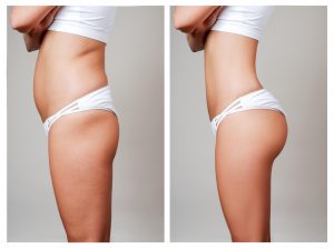A before-and-after shot. A female stands in profile from the chest down, arms crossed over her chest. She is wearing a white half-shirt and white bikini bottoms to show the changes in her stomach and butt after a cosmetic surgery procedure.