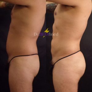 Before and after pictures of side of man that received BBL surgery