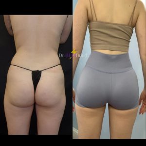 Before and after of female patient who received a Brazilian butt lift.