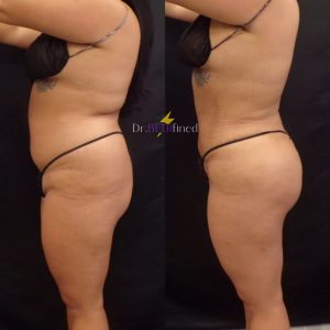 Before and after images of a patient from the side who received a BBL