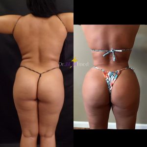 Before and after of female patient who received a Brazilian butt lift