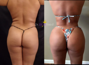 Before and after of woman who received a Vixen Brazilian butt lift from Dr. Bedi