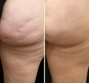 Before and after of a patient's butt cheek and leg after receiving Aveli cellulite treatment