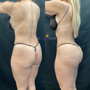 Before and after of a female patient who underwent a Brazilian butt lift.