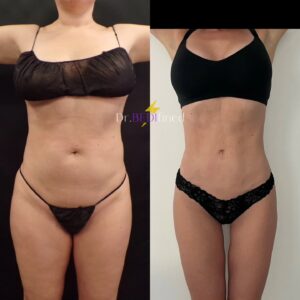 Before and after of a patient who underwent VASER lipo