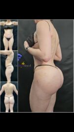 High Definition Athletic Buttock Augmentation 